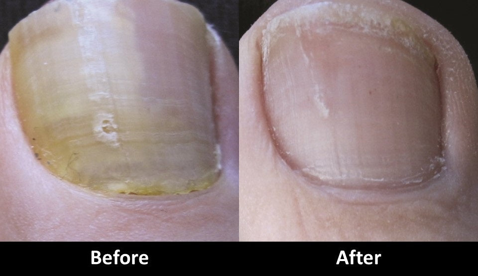 Laser Toenail Fungus treatment before and after