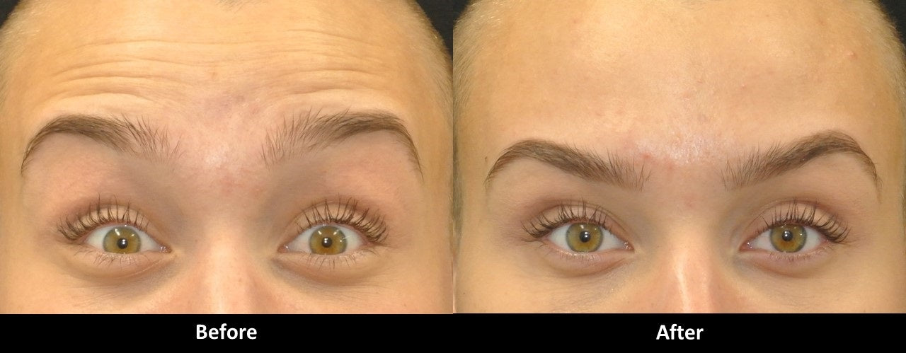 How to Correct Heavy Eyebrows after Botox