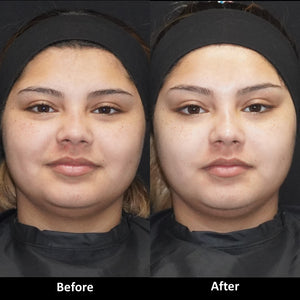 Amazing Results with Botox to Slim the Lower Face