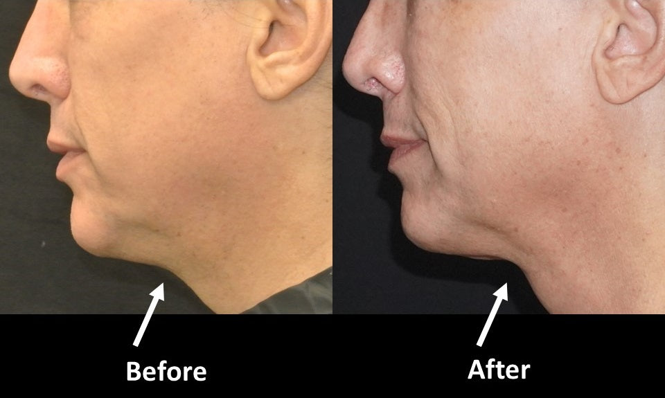 Amazing Kybella Results