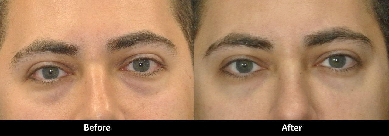 Treating Dark Circles Under the Eyes with Vollure