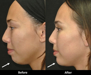 Voluma Now Approved for Chin Augmentation