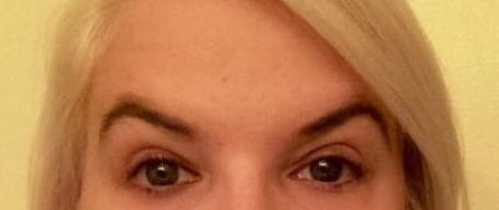 How to Correct Peaked Eyebrows Resulting from Botox