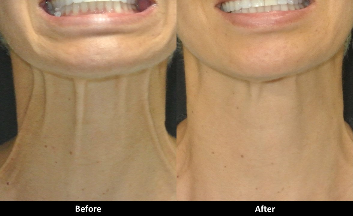 Botox for Neck Bands (60 units)