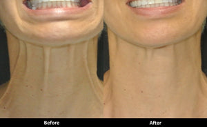 Botox for Neck Bands (60 units)