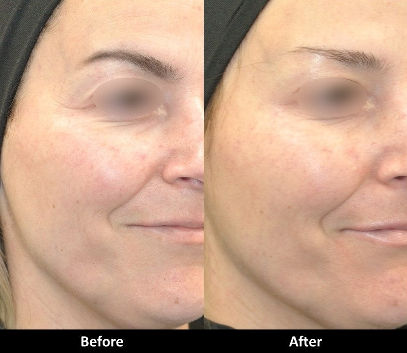 Botox before and after crow's feet