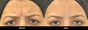 Botox before and after frown lines