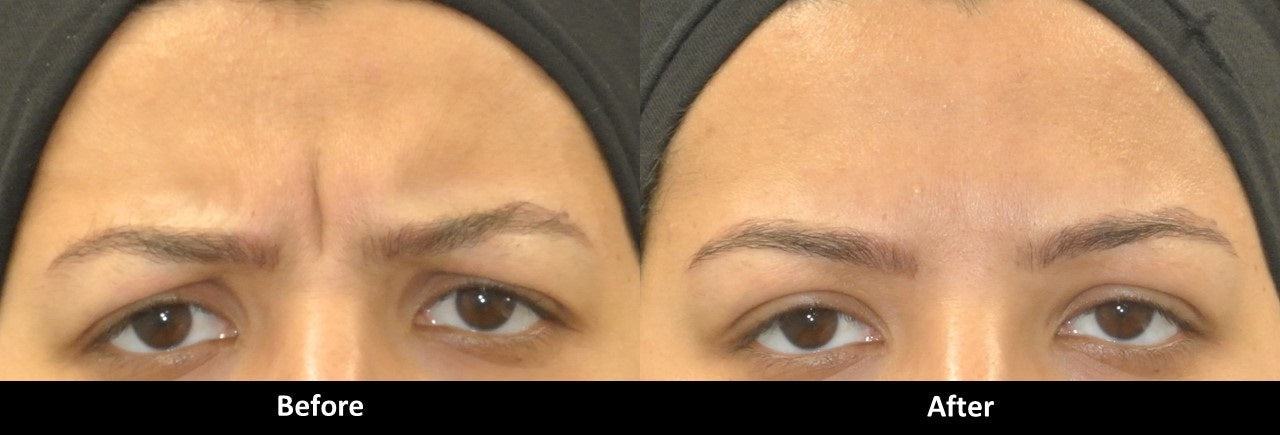 Botox before and after frown lines