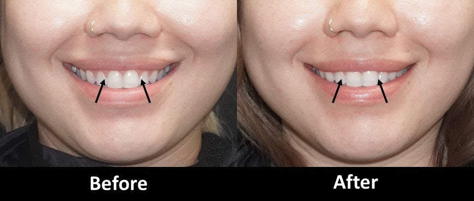 Botox before and after gummy smile