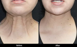 Botox for neck bands before and after