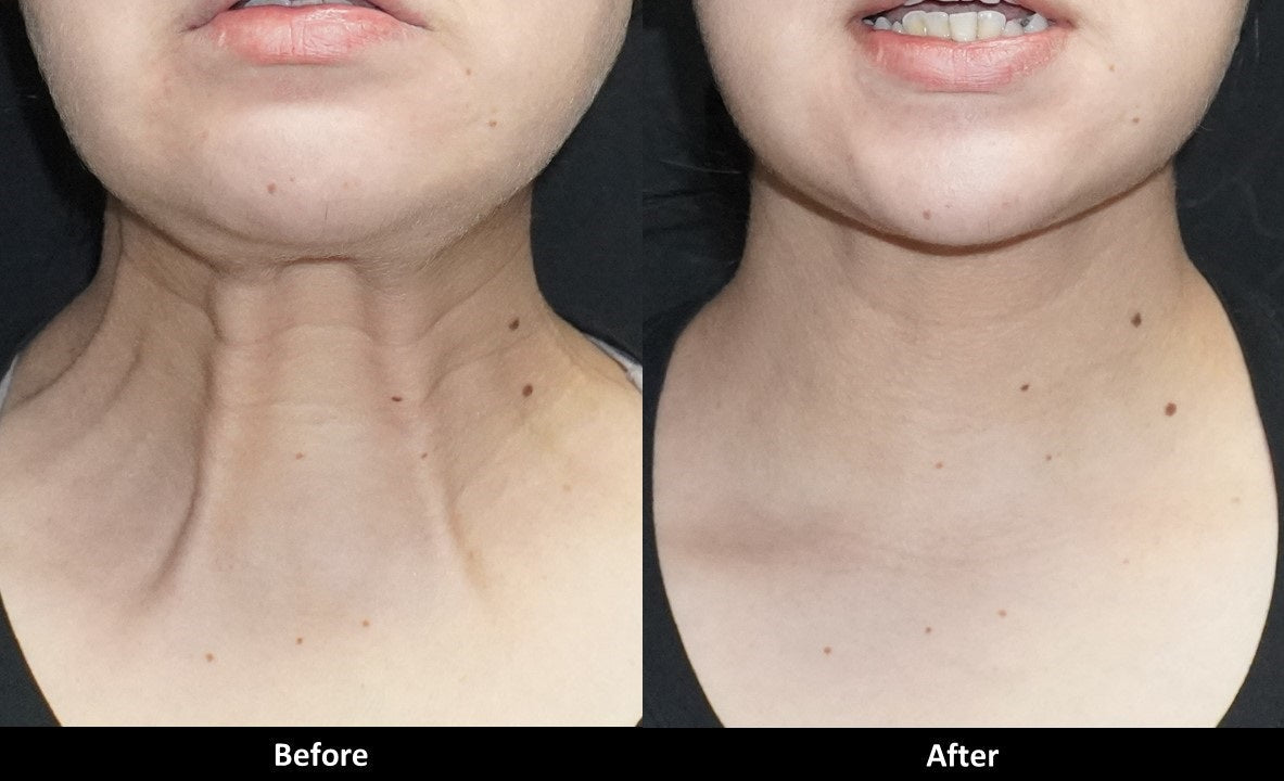 Botox before and after neck
