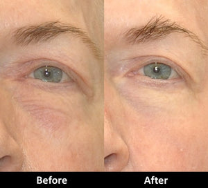 Fractional CO2 Laser Resurfacing before and after