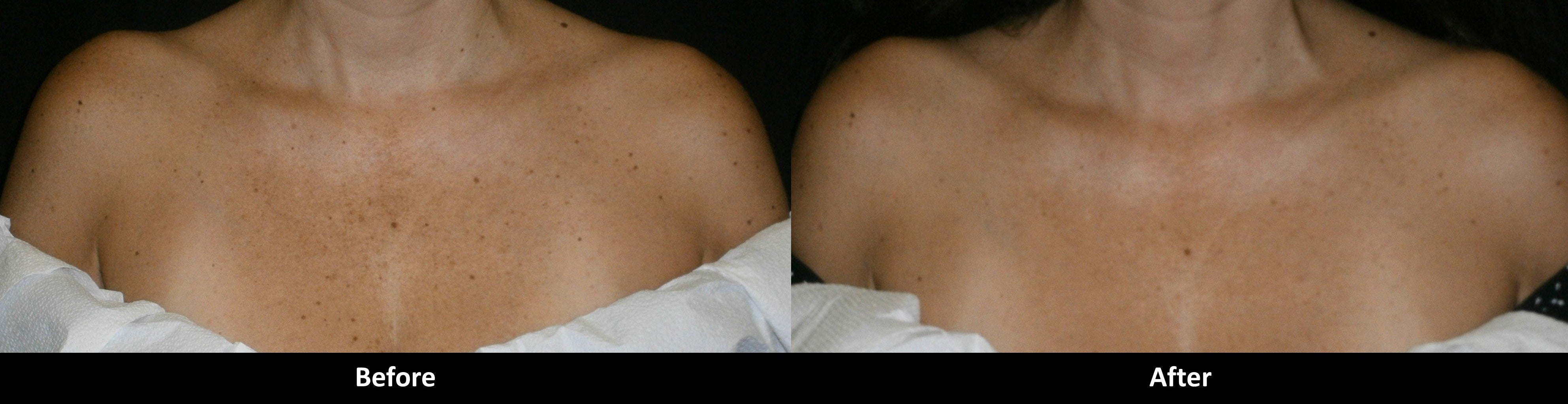 IPL photofacial before and after
