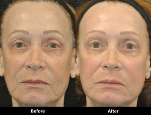 CO2 Laser Facial Rejuvenation: Fix Fine Lines, Wrinkles, Sun Damage &  Stretch Marks