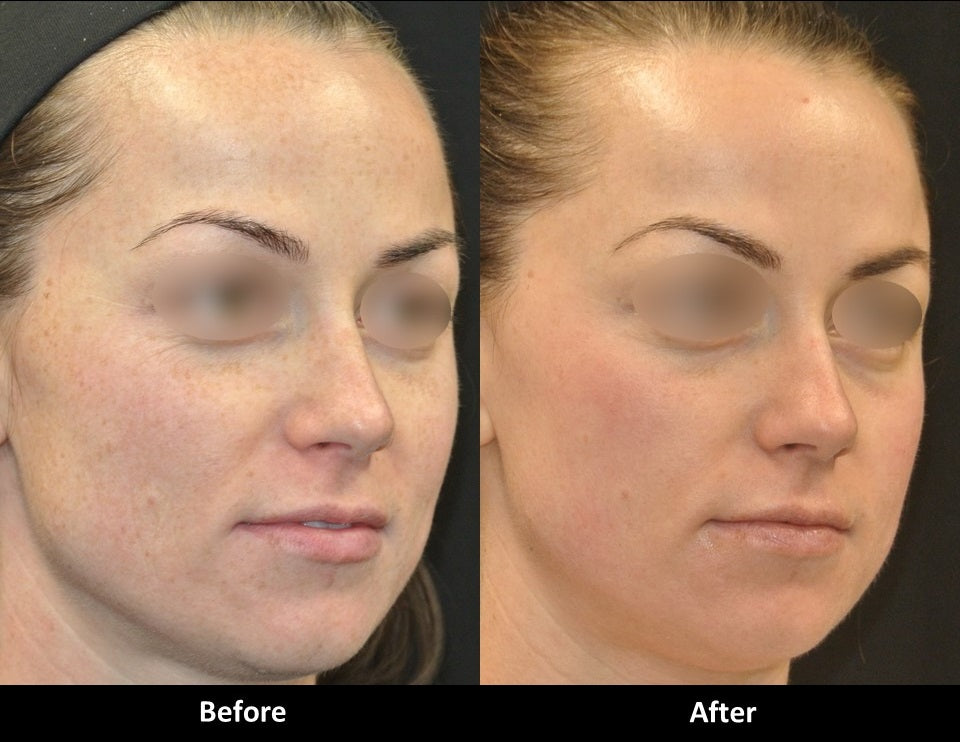 Fractional CO2 Laser Resurfacing before and after