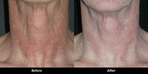 IPL photofacial before and after