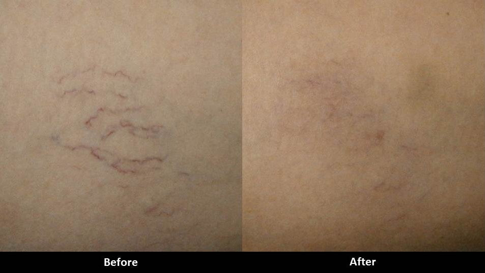Laser leg vein treatment before and after
