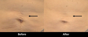 Laser Skin Tightening before and after