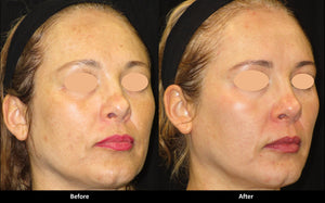Soft and Smooth Rejuvenation before and after