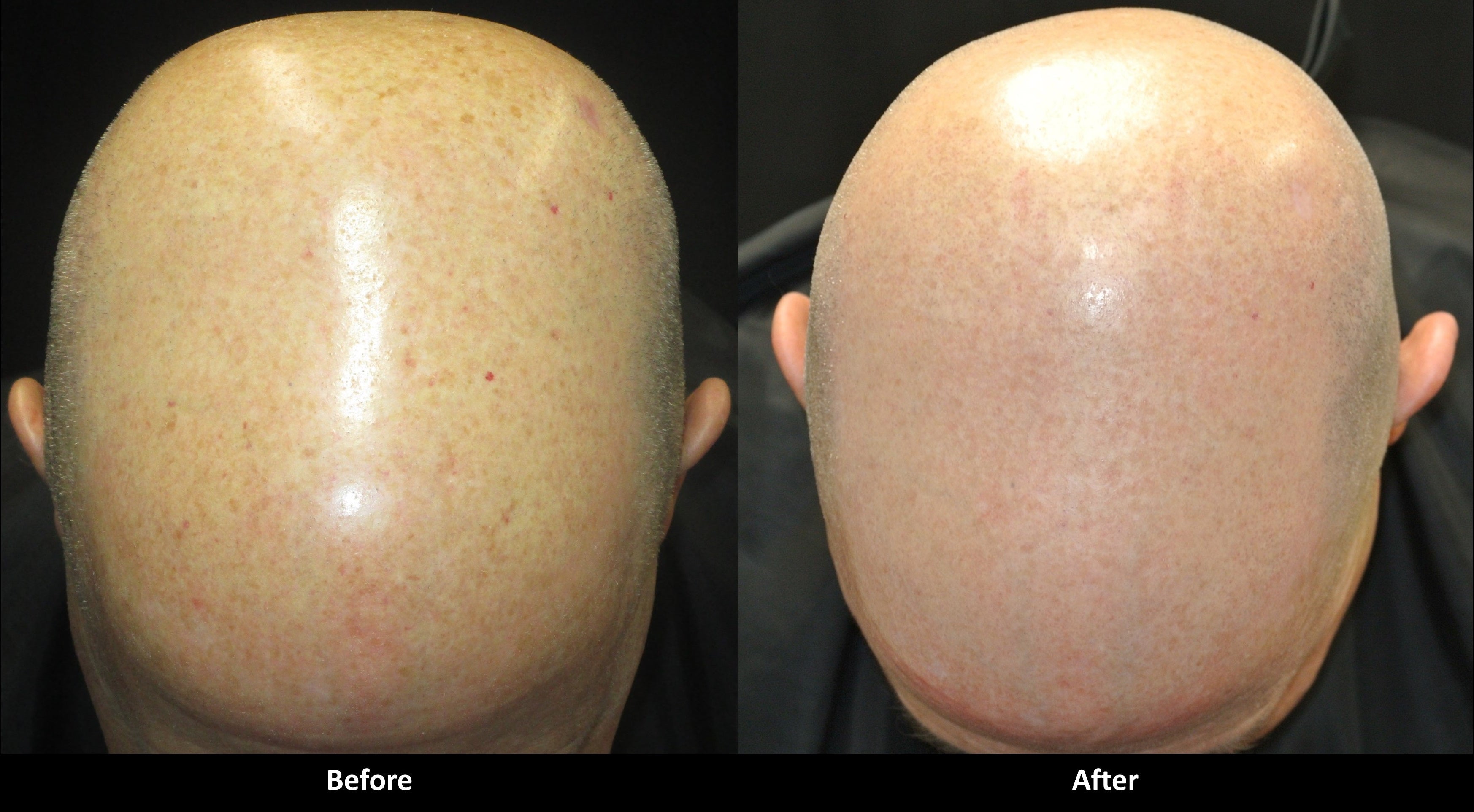 Soft and Smooth Rejuvenation before and after