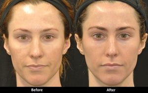 Tight and Bright Rejuvenation before and after