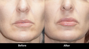 Volbella before and after lip enhancement