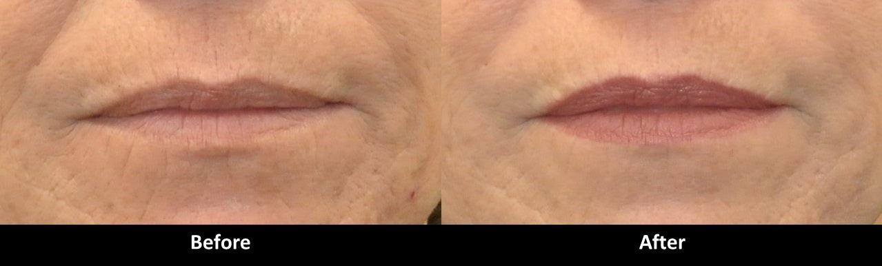 Volbella before and after lip lines