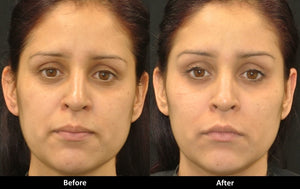 Voluma before and after