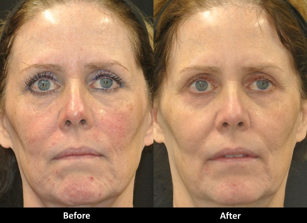 Tight and Bright Rejuvenation before and after