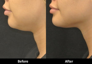 Laser Skin Tightening before and after