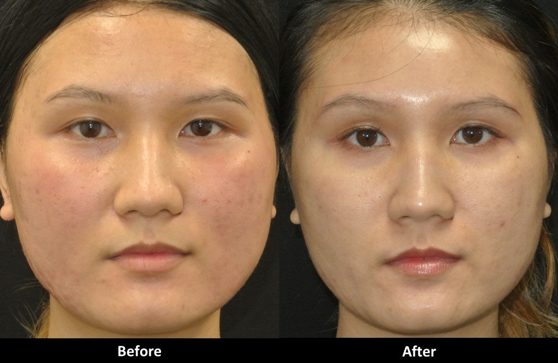 Ultra Microneedling before and after